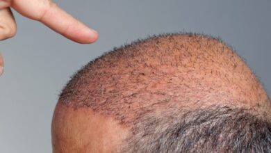 عملية زراعة الشعر قبل وبعد